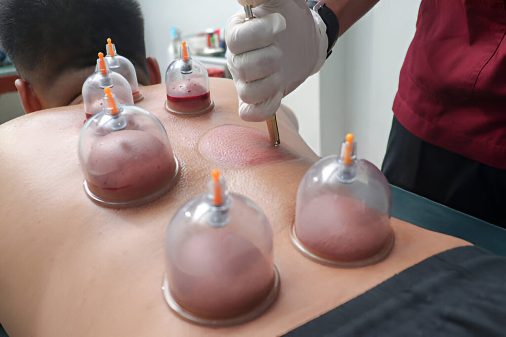 Hijama Therapy in Abu Dhabi