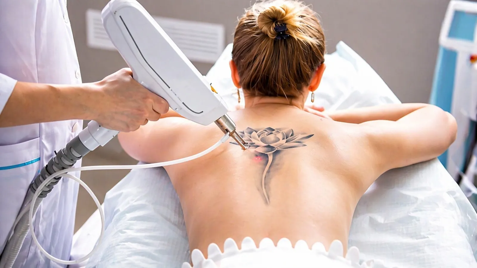 tattoo removal